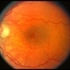 Adult Vitelliform Dystrophy